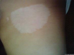 如何正确对待女性白癜风患者呢 如何正确对待女性白癜风患者呢.jpg