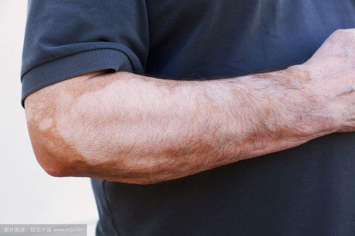男性白癜风治疗 男性白癜风治疗.jpg