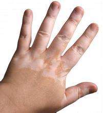 白癜风危害 白癜风危害.jpg