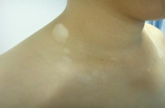 老人该如何预防白癜风病呢 老人该如何预防白癜风病呢.jpg