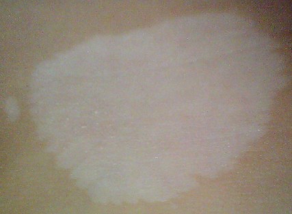 白癜风有哪些诊断方法.jpg