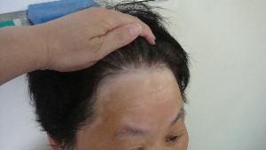 面部白癜风有哪些护理要点呢.jpg