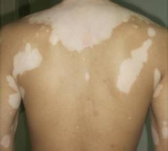 白癜风对于患者的危害太大了 白癜风对于患者的危害太大了.jpg