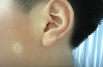 白癜风饮食 白癜风饮食.jpg