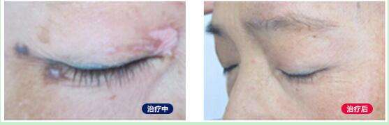 白癜风治疗 白癜风治疗.jpg