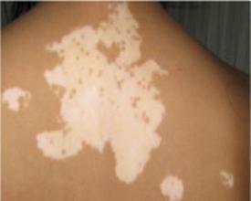 预防白癜风好的方法是什么 预防白癜风好的方法是什么.jpg